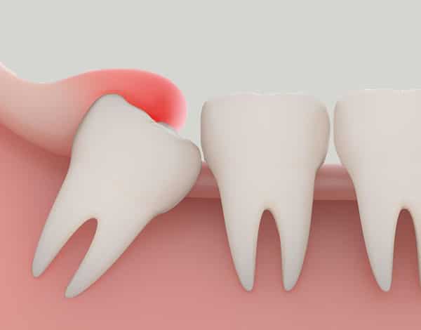 چرا دندان عقل باید کشیده شود؟