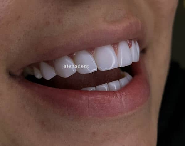 عکس کامپوزیت دندان