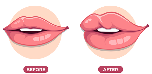 فیلر لب