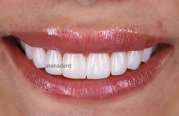 پالیش کامپوزیت دندان