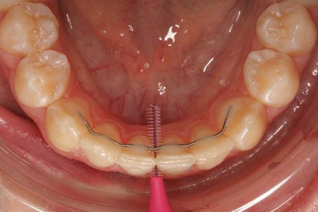 تمیز کردن ریتینر ارتودنسی