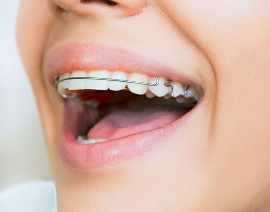 ریتینر ارتودنسی