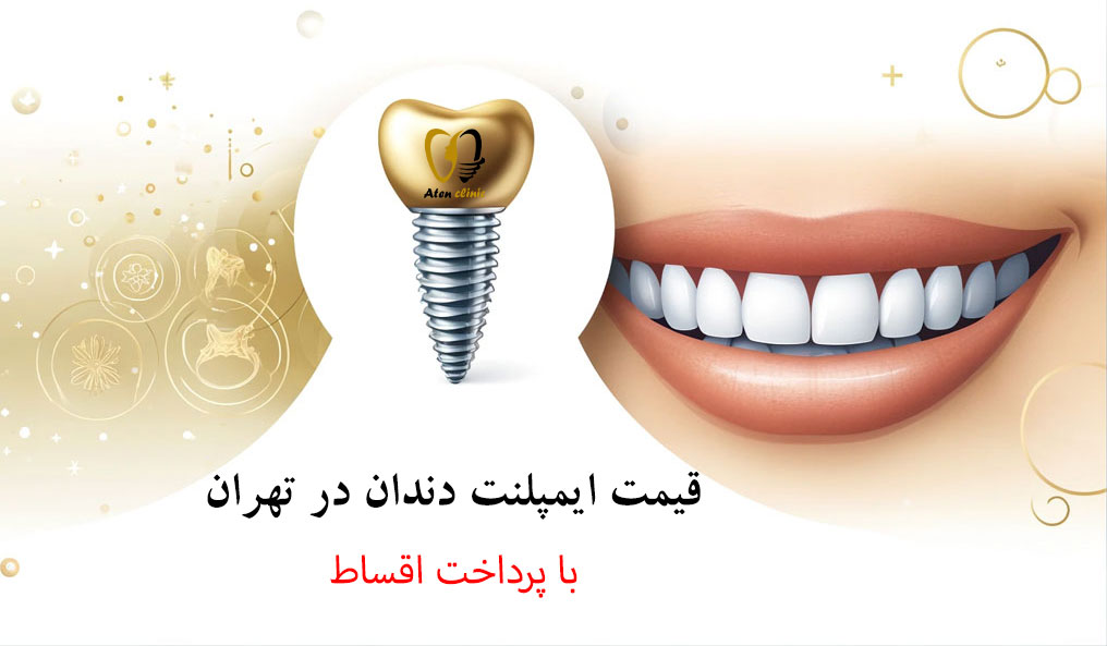 قیمت ایمپلنت دندان در تهران