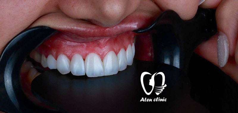 کامپوزیت های دندانی