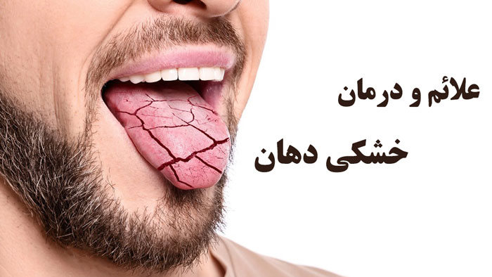 علائم و درمان خشکی دهان