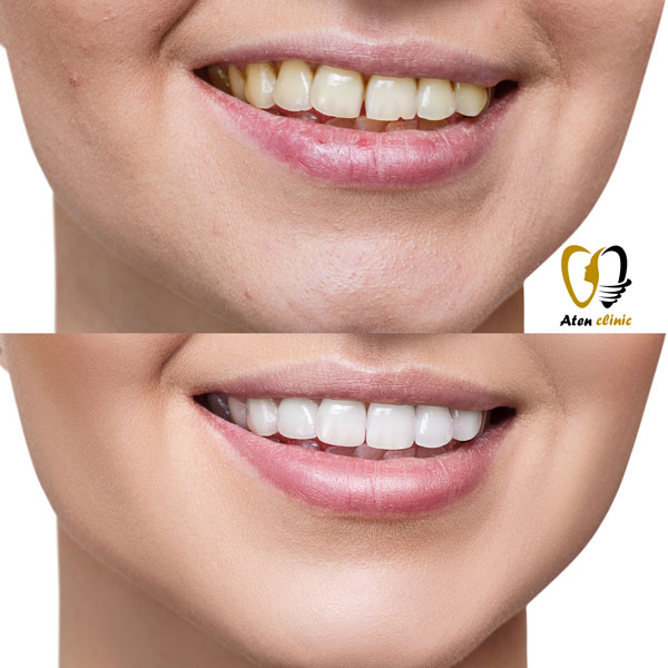 فاصله بین دندان ها