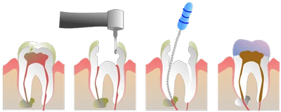ارتباط عصب کشی دندان با روکش دندان