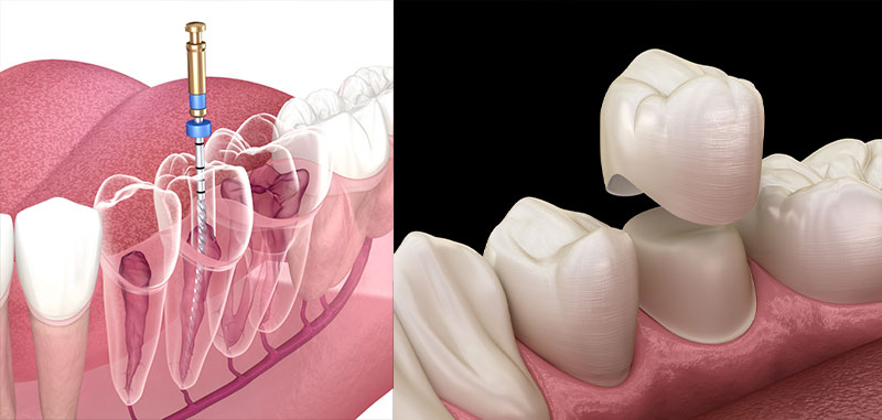 چرا بعد از عصب کشی به روکش نیاز دارید؟