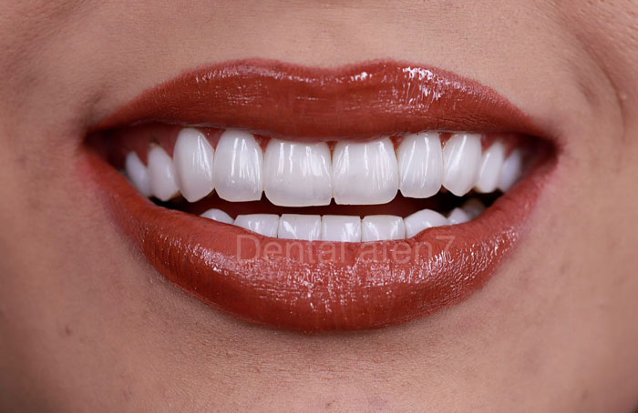 کامپوزیت دندان چیست؟