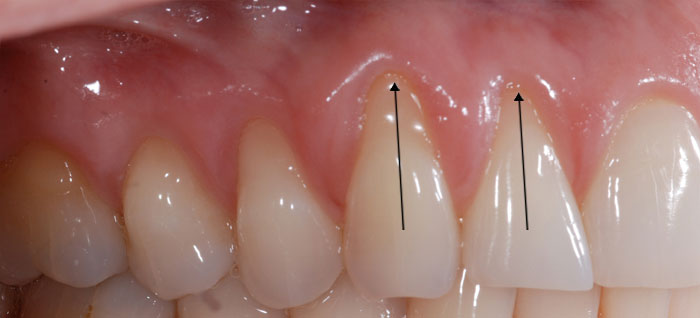 عقب نشینی لثه ها